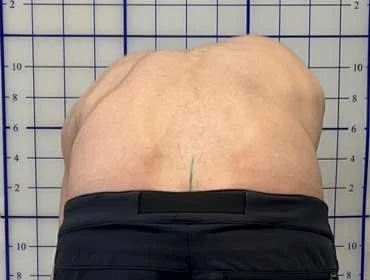 The Scoliotic Prominence and Muscle Length-Tension Relationship ...