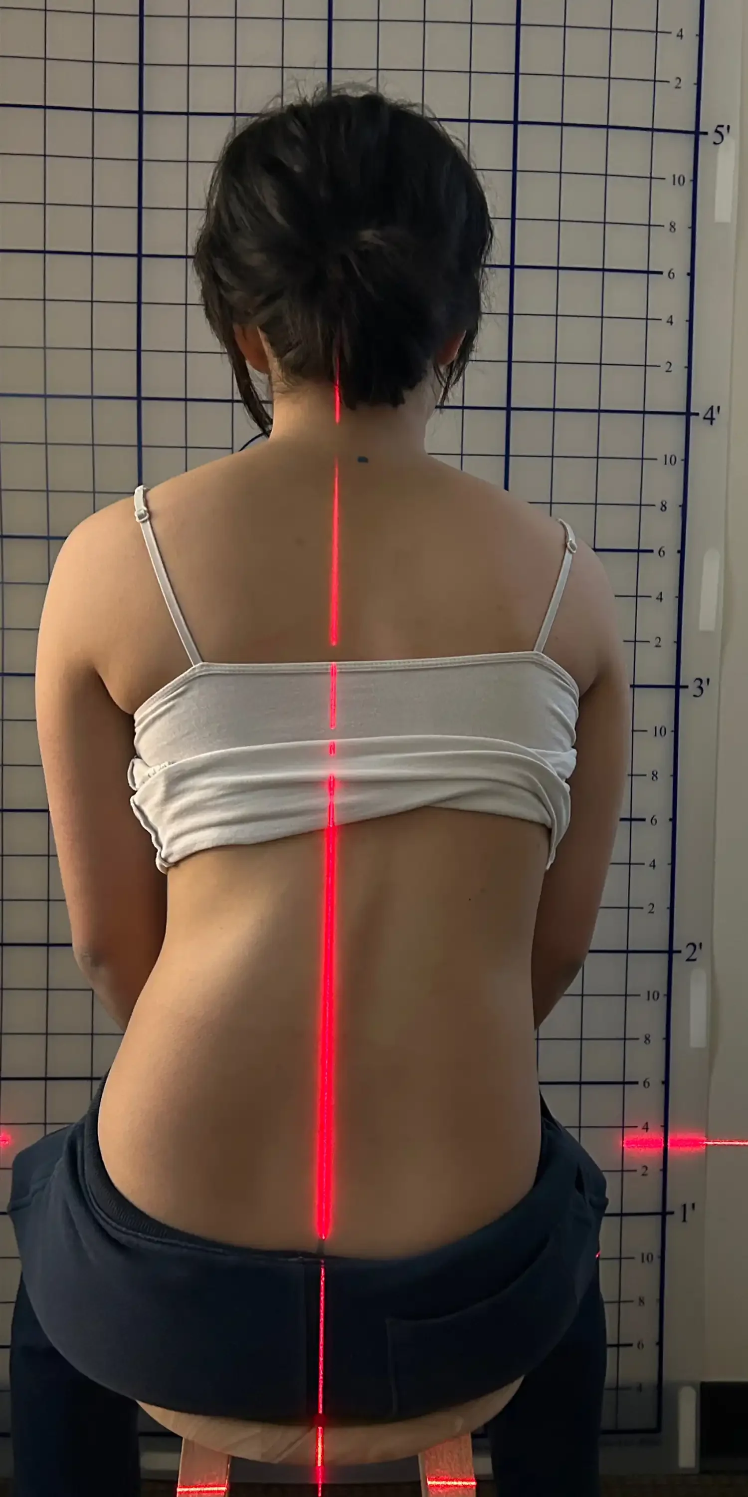 23 year old before scoliosis transformation