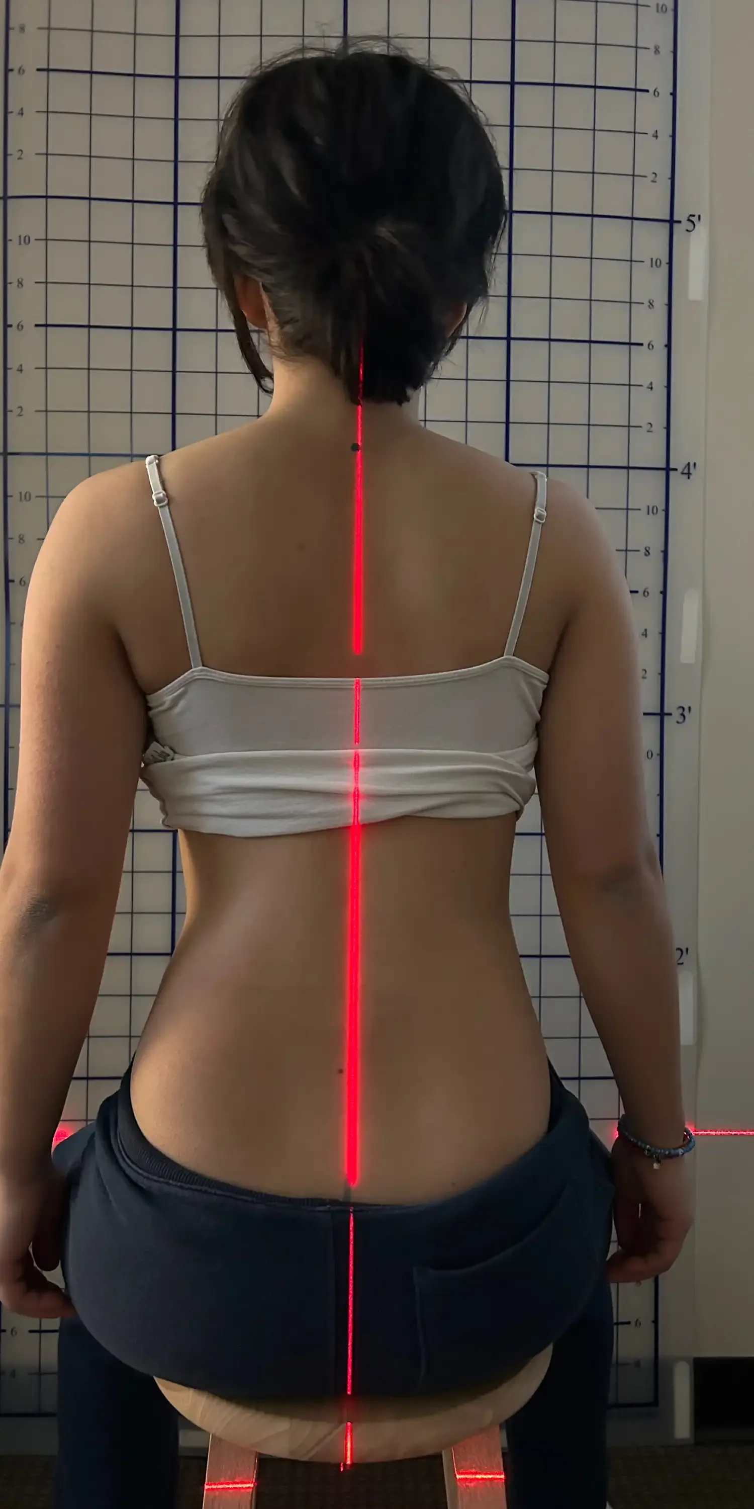 23 year old after scoliosis transformation