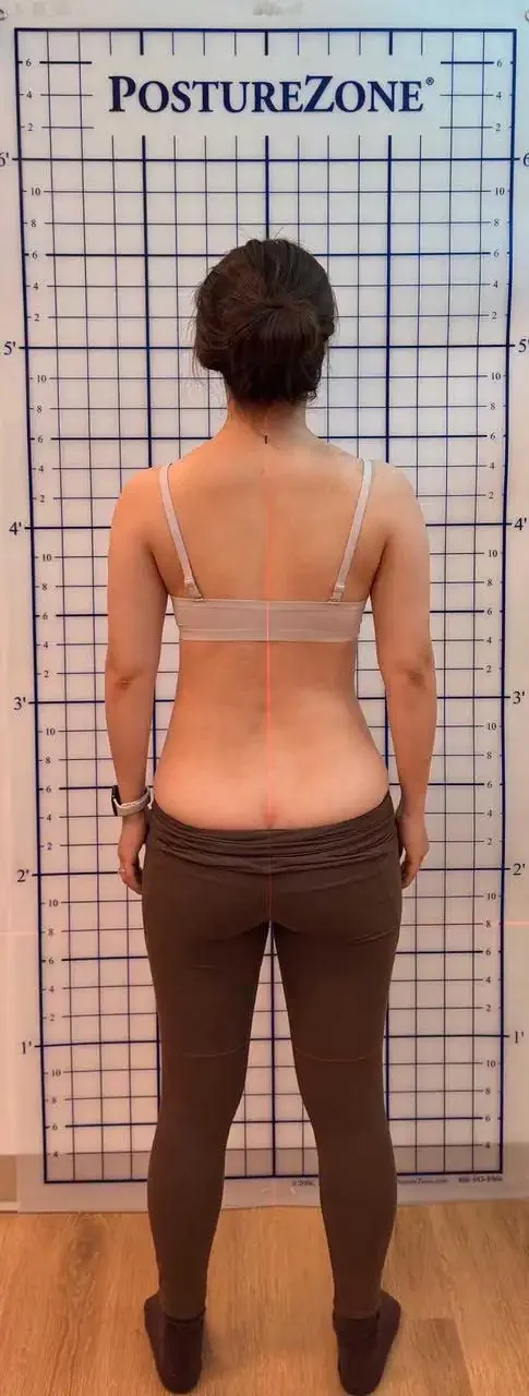 after scoliosis transformation