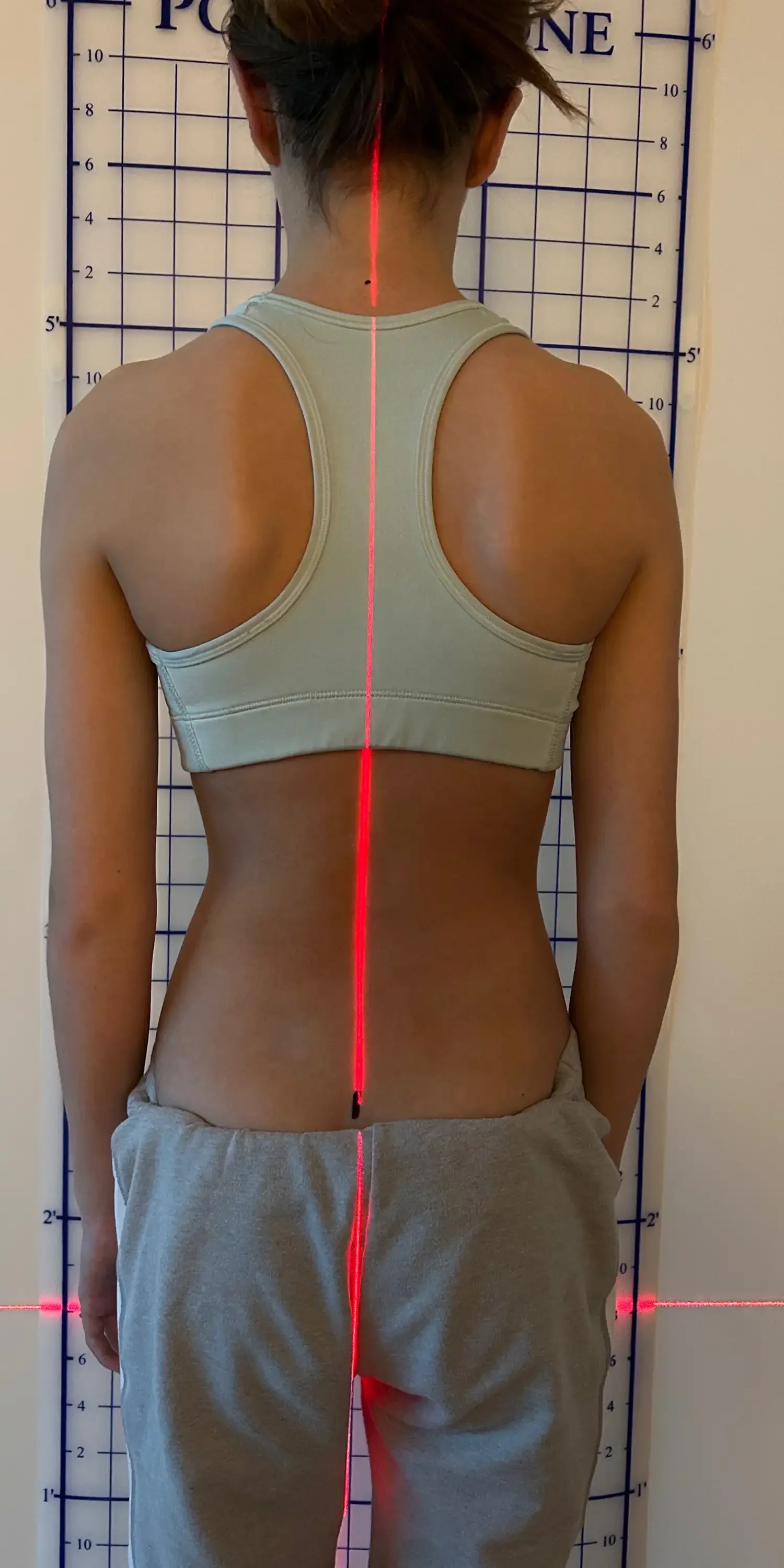 14 yr old scoliosis after transformation