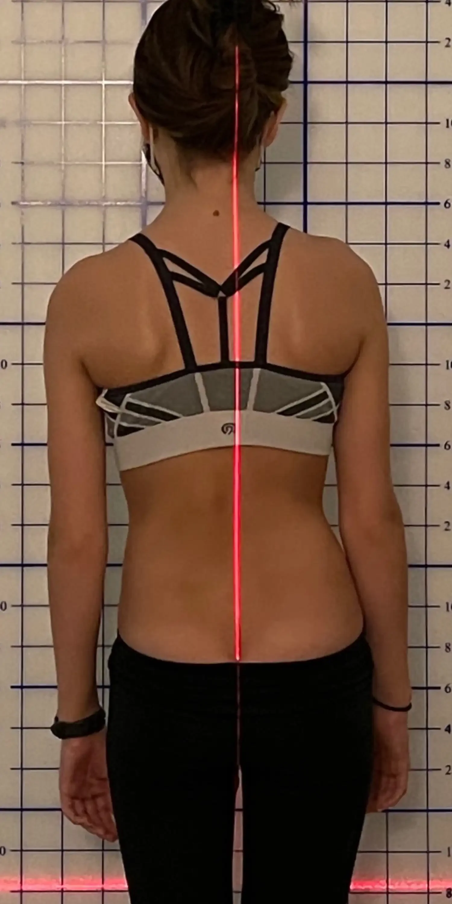 14 yr old before scoliosis transformation