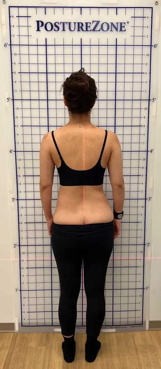 before scoliosis transformation