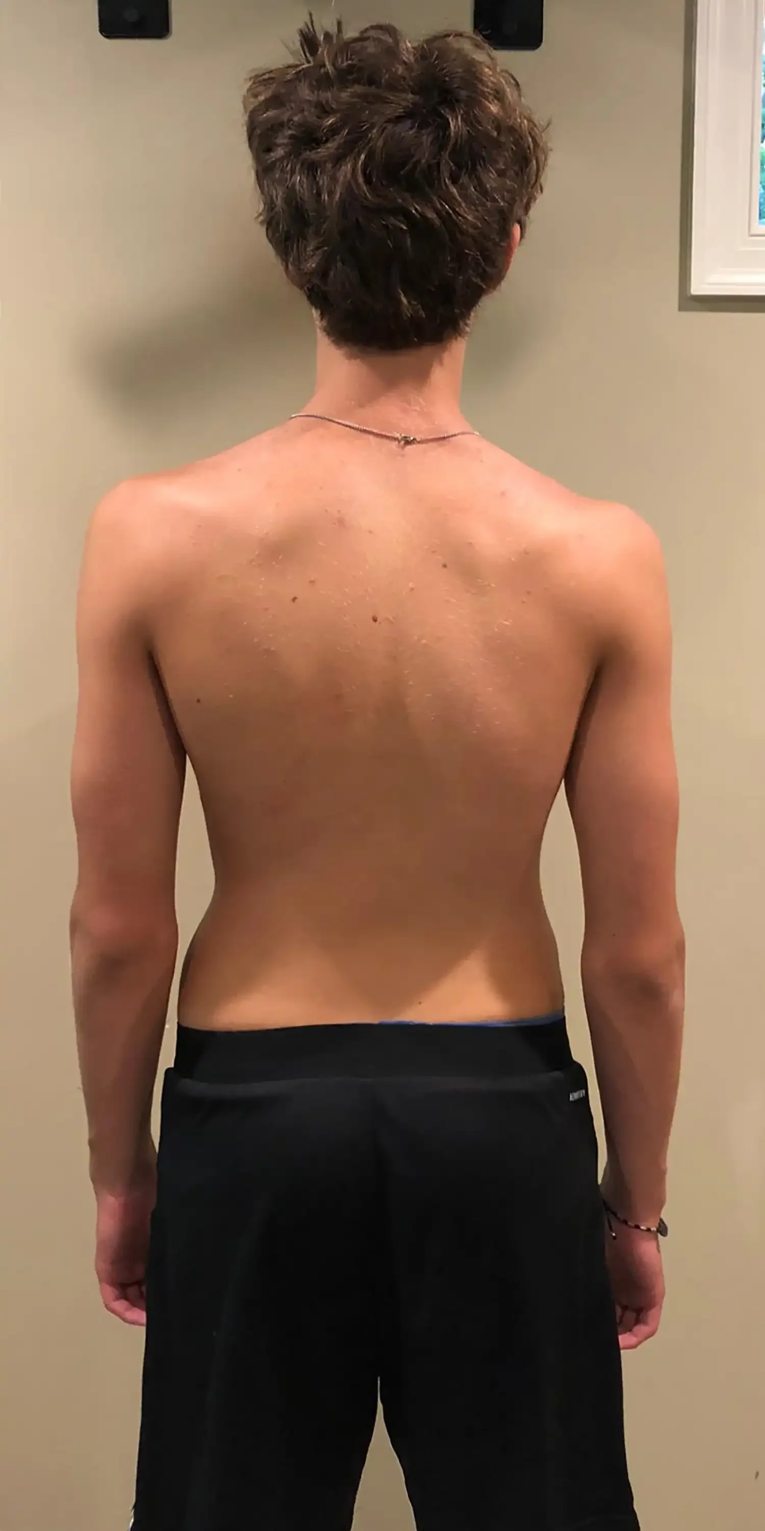 after scoliosis transformation