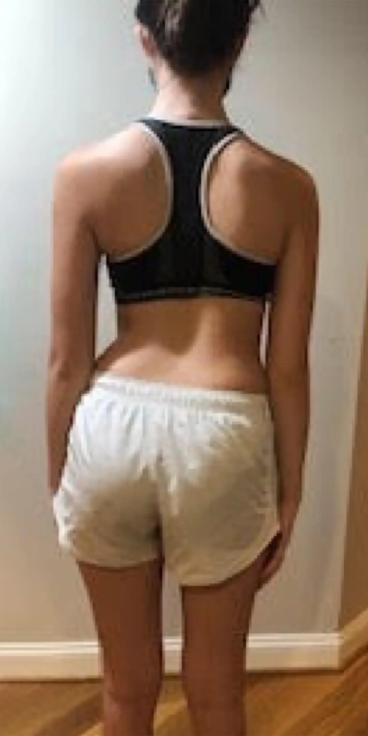 before scoliosis transformation
