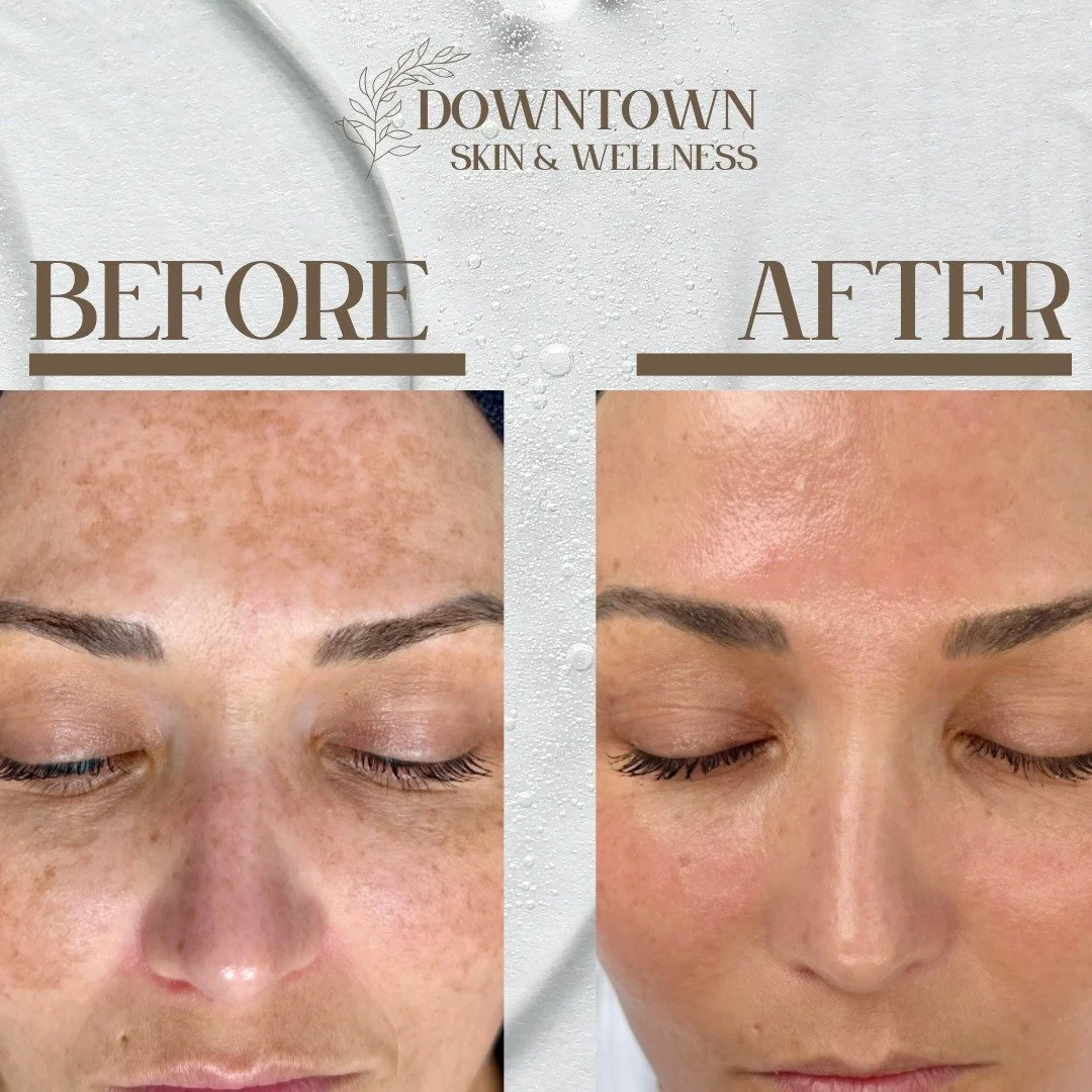 Seeing real result like this is one of our favorite parts of our job! 🤍

Tetra CoolPeel&reg; helps improve overall skin clarity, tone, and texture in a single session for many patients. This advanced CO₂ laser treatment helps improve skin tone, text