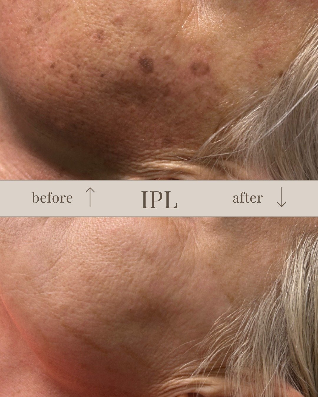 One of the things we love most about IPL is how naturally it improves the skin. IPL treatments work beneath the surface to target sun damage, dark spots, and uneven tone, helping the skin appear clearer, brighter, and more balanced. Results are gradu