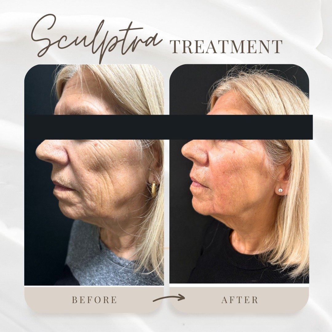 One of the most common things we hear after Sculptra: &ldquo;I still look like myself! Just more refreshed.&rdquo;

This before &amp; after shows why it&rsquo;s such a favorite for subtle, natural-looking results. ✨