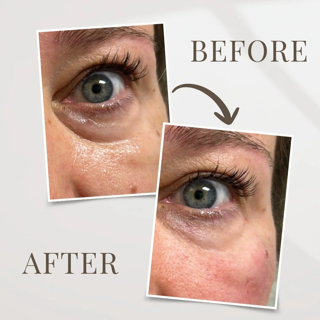 If your under-eyes always make you look more tired than you feel&hellip; this is your sign 👀 Smoother, brighter, and refreshed, without losing what makes you you.

Say goodbye to the &ldquo;I&rsquo;m exhausted&rdquo; look (even if you are 😉)