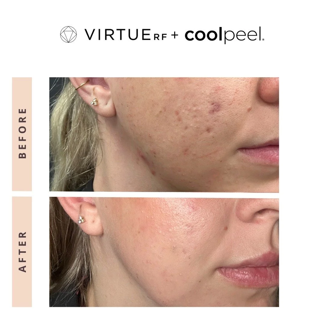 Acne, texture, and uneven skin? This combo does it all. 

✨ VirtueRF: targets deeper layers to stimulate collagen and improve skin structure
✨ CoolPeel: resurfaces the top layer for smoother, clearer skin

Together = clearer, brighter, more refined s