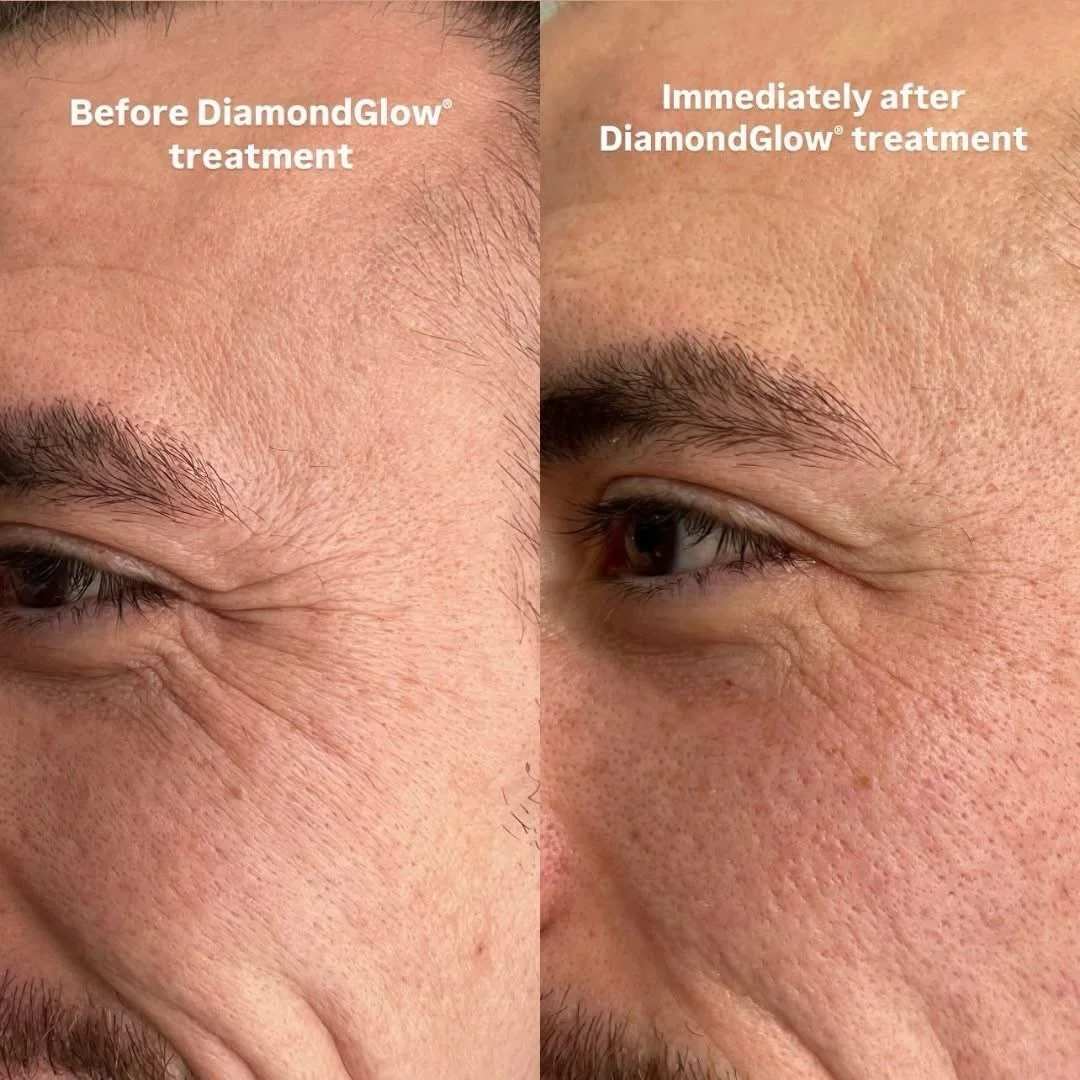 We call this a #DiamondGlow Up ⬆️✨😉

Enhance your radiance with a #DiamondGlow treatment today!
Call Us To Book 📞: 352-437-4393