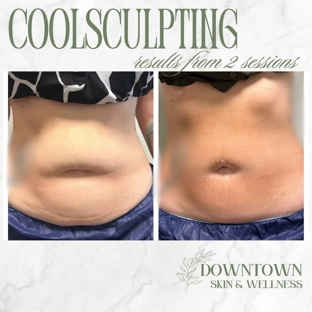 Chill out. Slim down. ❄️
✨ No Surgery.
✨ No Downtime.
✨ FDA-Cleared.

📸 The proof is in the progress&mdash;visible results after only 2 sessions! DM us to book your appointment today!