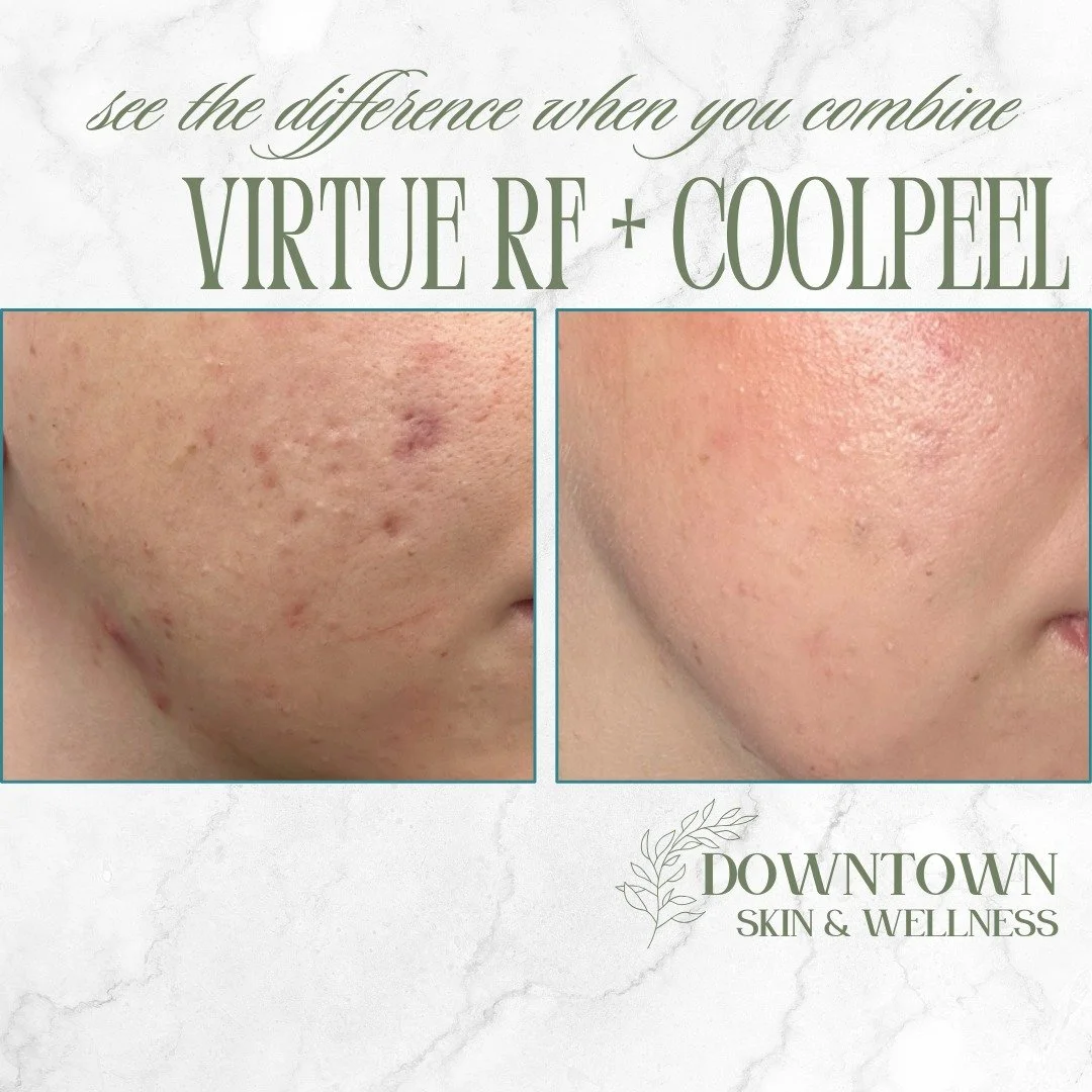 The ultimate power couple for acne scars and skin texture. 👑✨

When you combine Virtue RF and CoolPeel, you&rsquo;re not just getting two great treatments&mdash;you&rsquo;re getting a total skin transformation. This before-and-after speaks for itsel