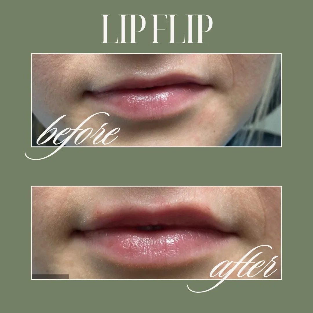 The ultimate summer beauty hack? The Lip Flip. ☀️💋

No filler. No downtime. Just a subtle, perfected pout that keeps your top lip from hiding when you smile. It&rsquo;s quick, non-invasive, and the ultimate subtle glow-up.

And because it&rsquo;s Ju