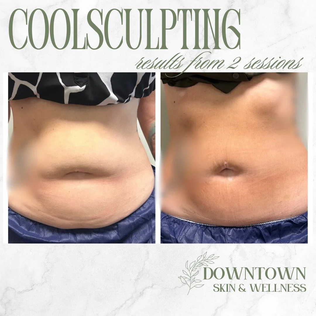 The coolest way to get summer ready? Freezing away the stubborn spots. 🤫

Diet and exercise are great, but sometimes you need a little extra help targeting those stubborn areas. Introducing CoolSculpting; the ultimate non-invasive body contouring tr