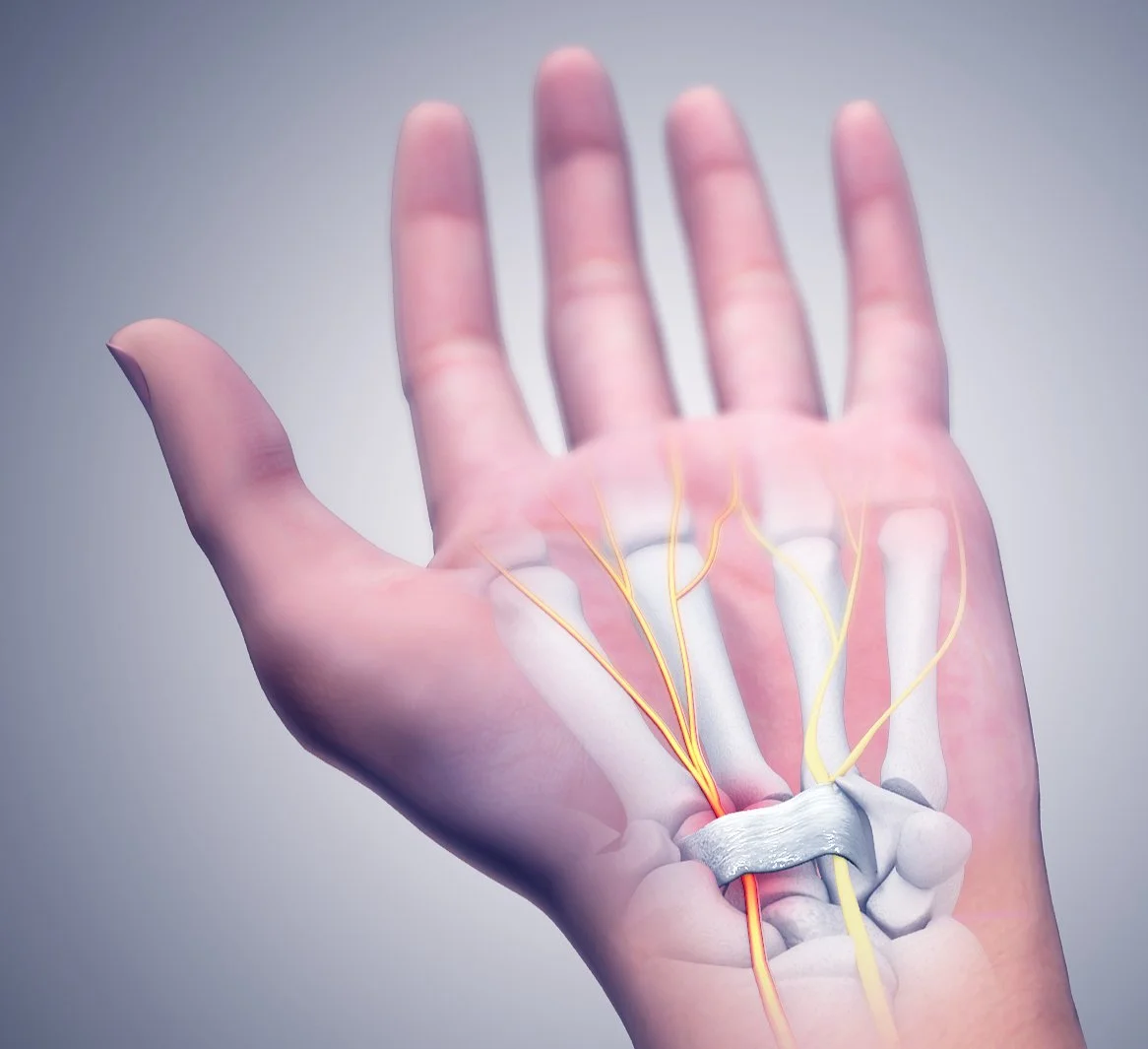 Carpal_Tunnel_Syndrome.jpeg