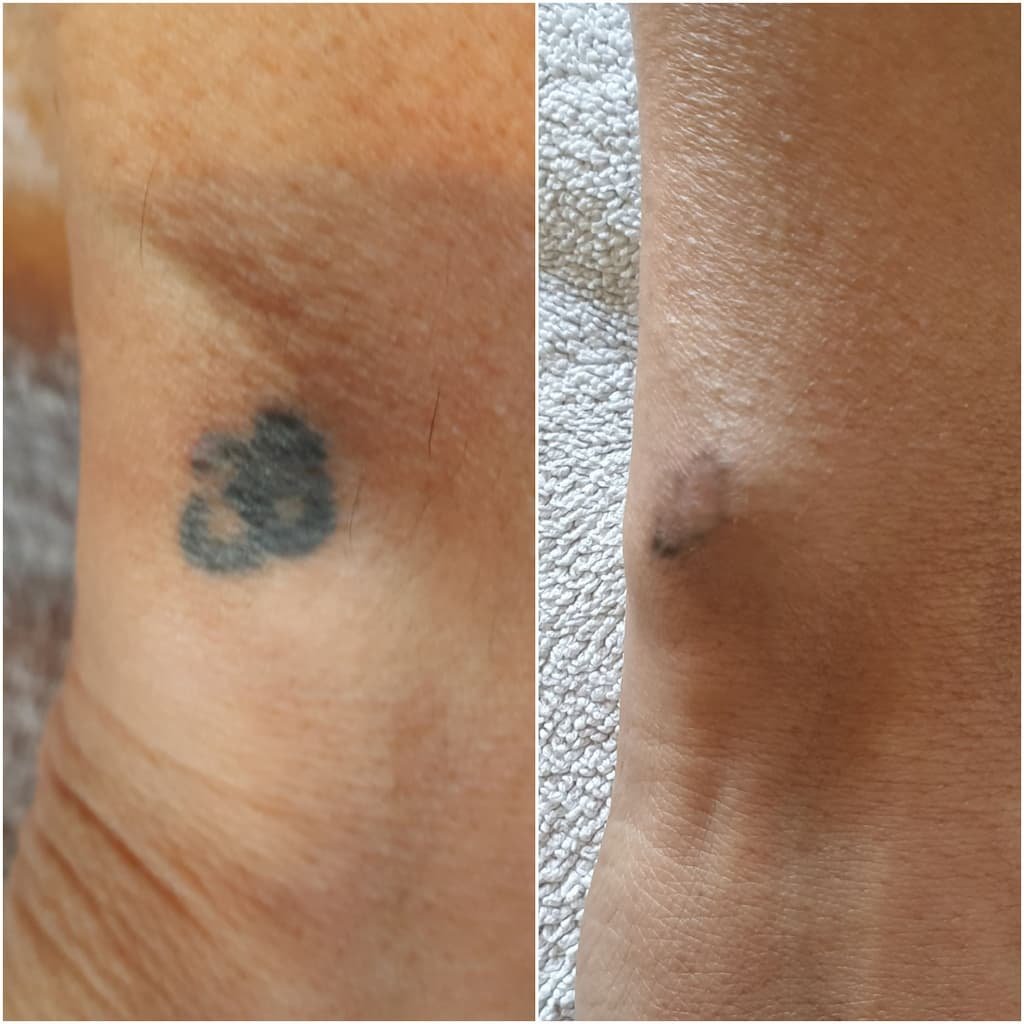 Tattoo removal before and after What laser treatment is really like   Newshub