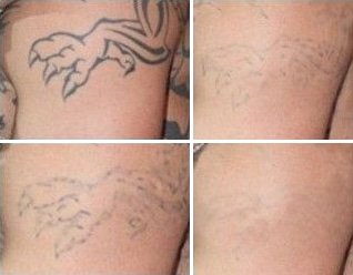Share 65 laser tattoo removal nz latest  thtantai2