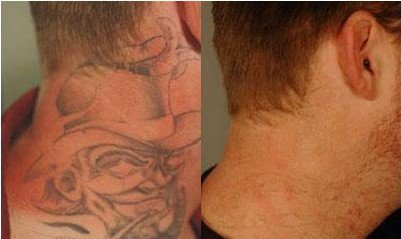 Cover up your old Tattoo by clearing the way with Tattoo RemovalLightening    Sacred Laser