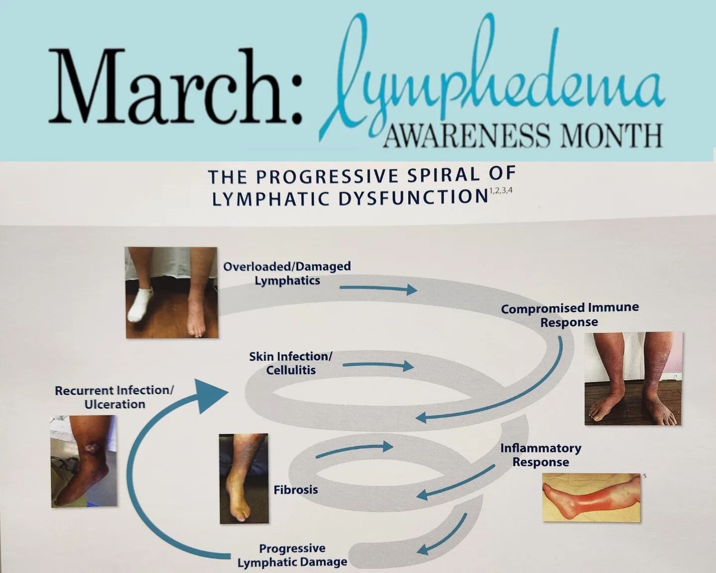 March is Lymphedema Awareness Month! Ask us today how we can help your swelling!

#jenmobilityrehab 
#occupationaltherapy 
#lymphedema 
#lymphedemaawarenessmonth