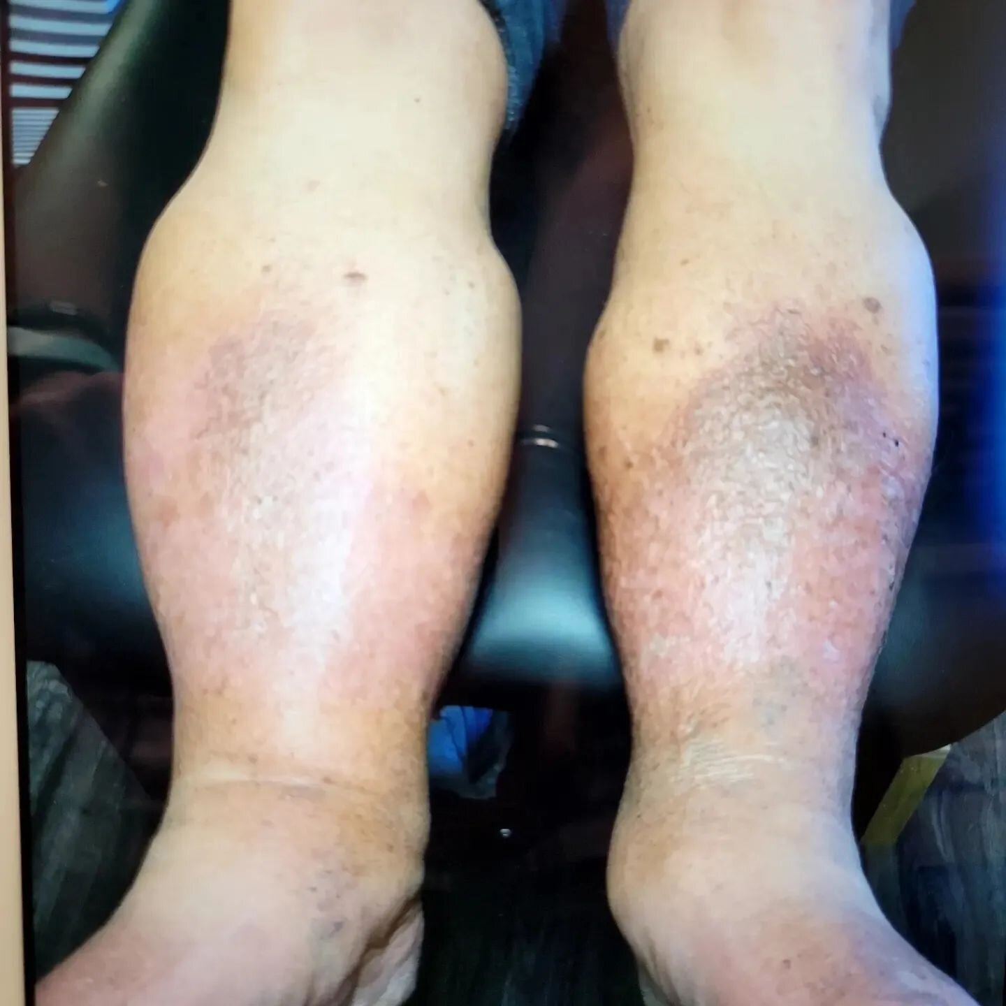 Do you or someone you love have swelling in their legs? We can help! Give us a call today 423-545-9544 to learn how to improve swelling and quality of life!

#jenmobilityrehab 
#lymphedema