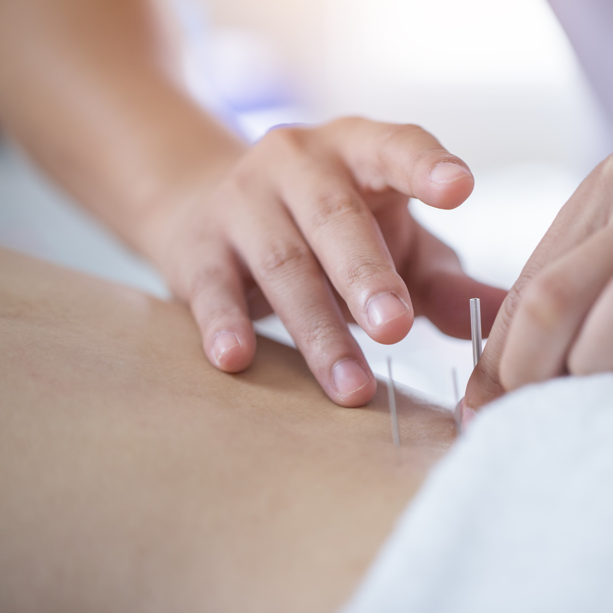 Dry Needling in Kombination mit Physiotherapie in der Natura Heilpraxis Berlin