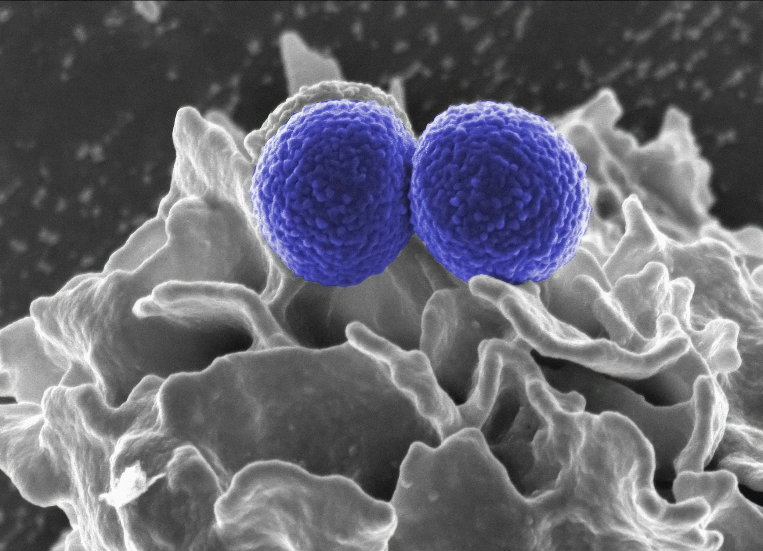 Meningitis B outbreak - Frequently Asked Questions