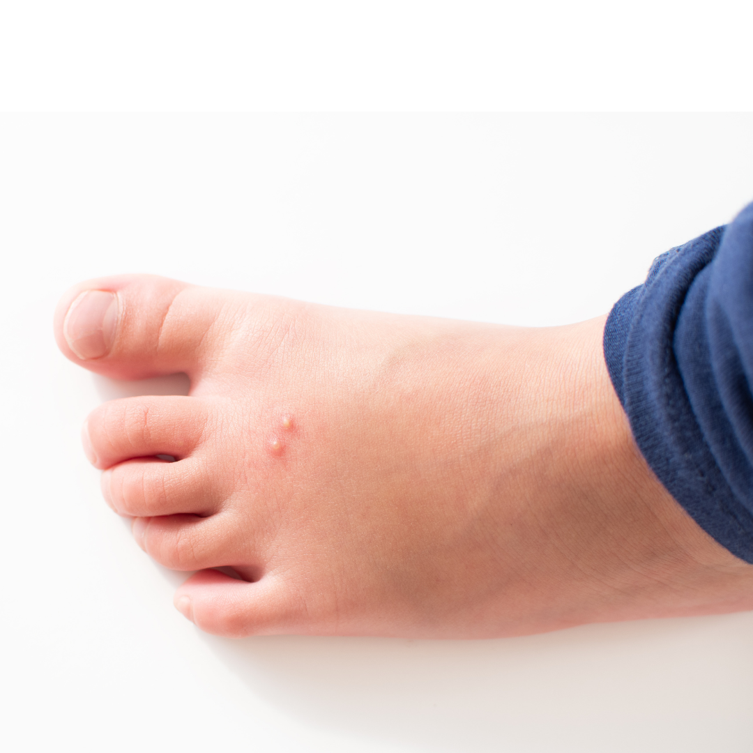 Fire Ant Allergy: More Dangerous Than You Think