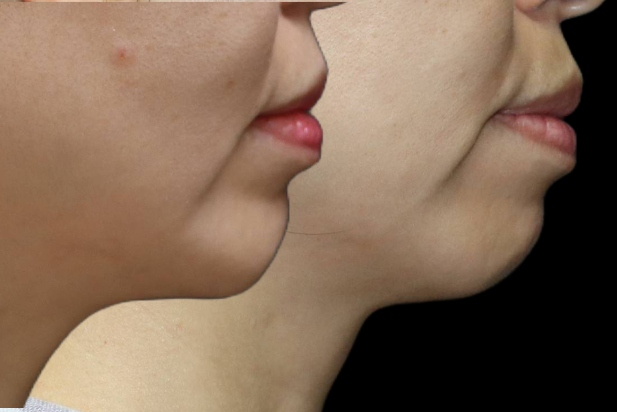Chin Augmentation with Implant