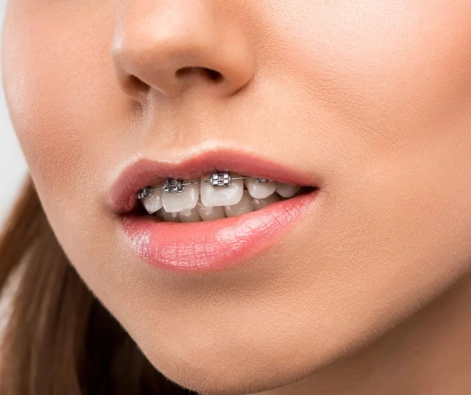 What Causes a Lisp in Adults? Causes, Types, and Speech Therapy