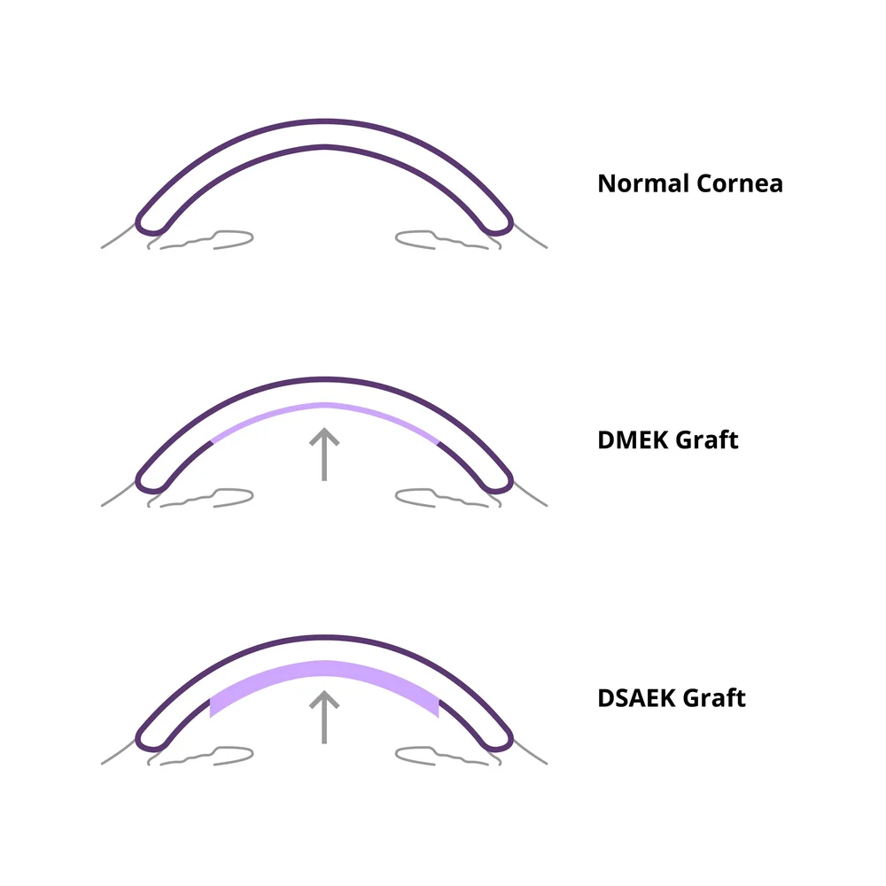 Corneal Transplant — Advanced Laser & Cataract Center Oklahoma
