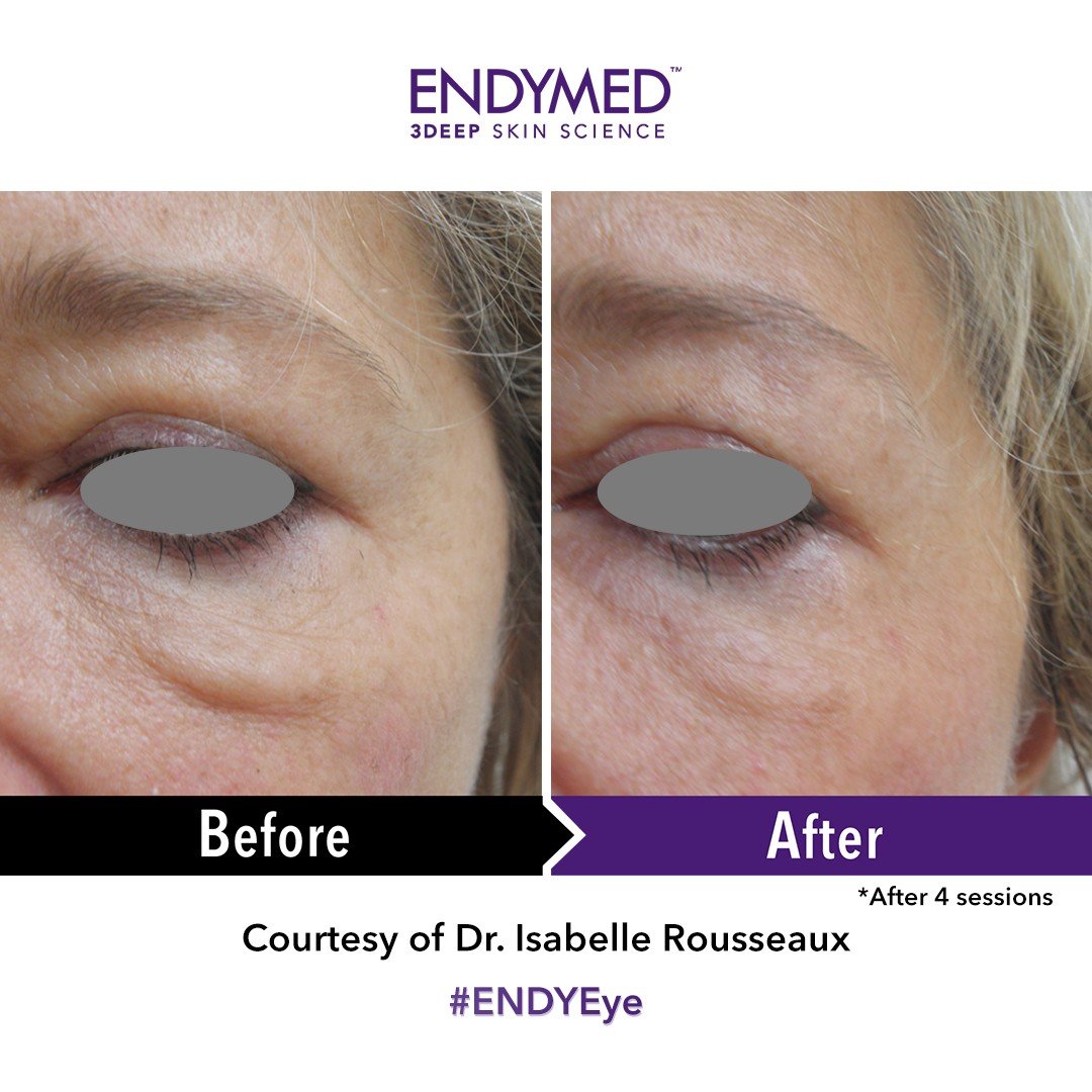 Endymed EyeLift