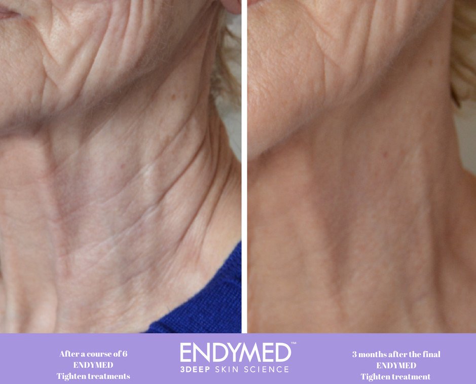 Indulgence Beauty B&A (1).jpeg