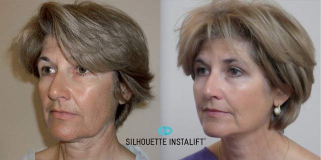 a-to-zen-instalift-before-after-bellevue-wa.jpeg