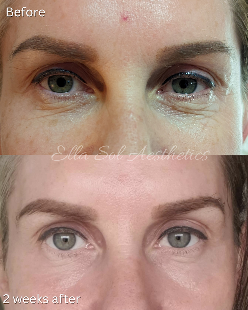 Fibroblast before and after on the eyes and forehead
