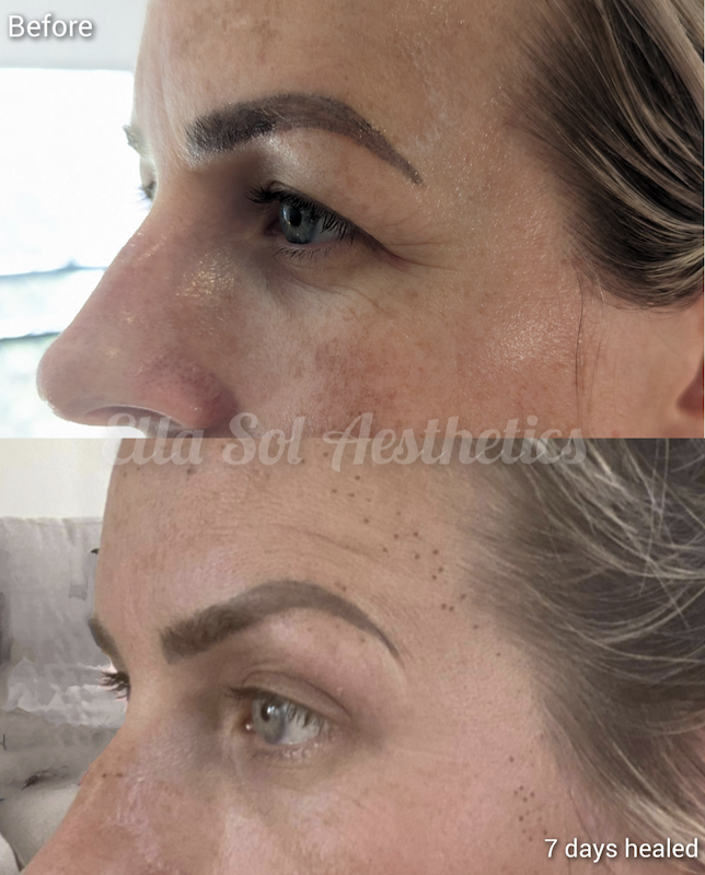 Fibroblast before and after on the eyes