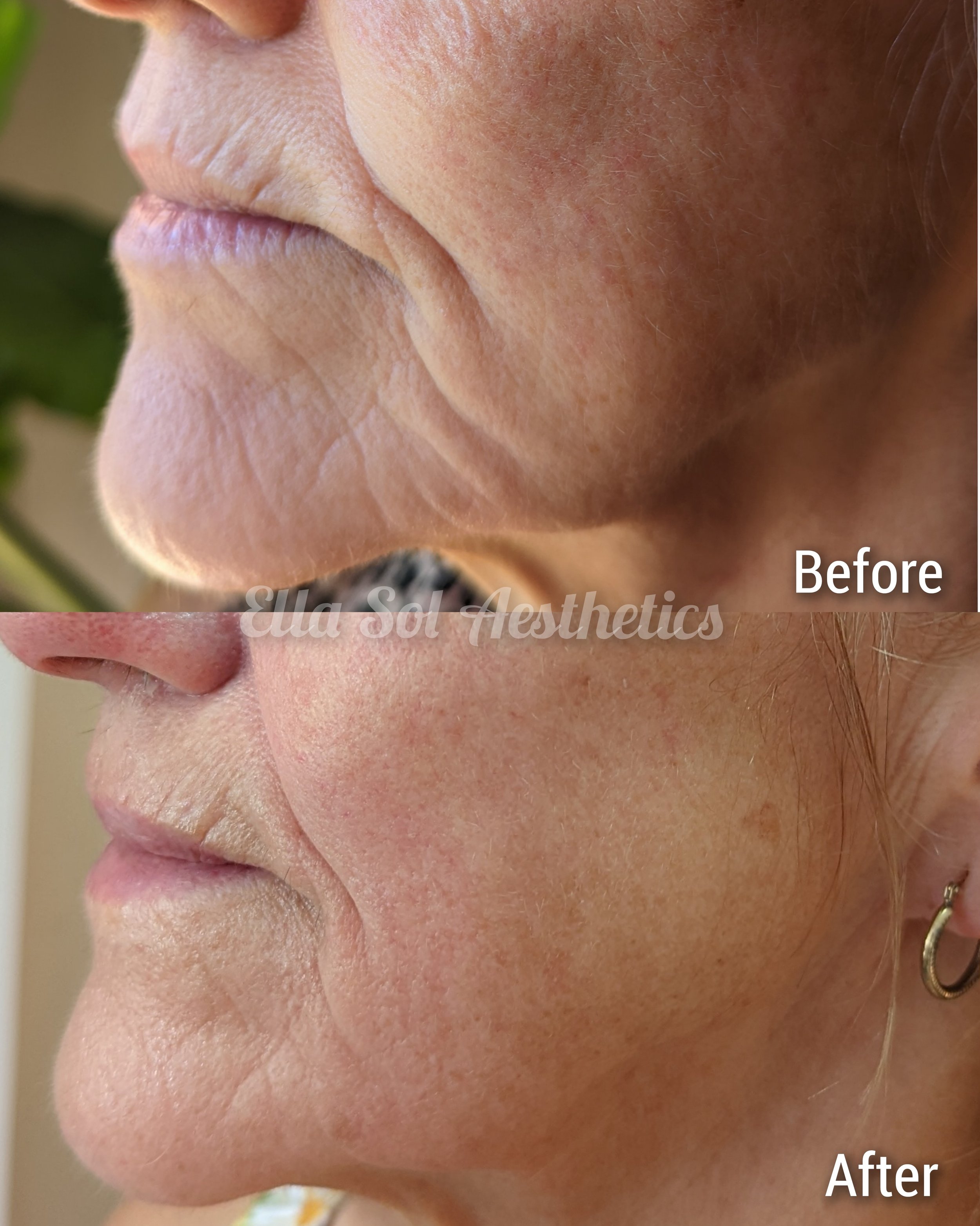 Fibroblast before and after on the jaw line