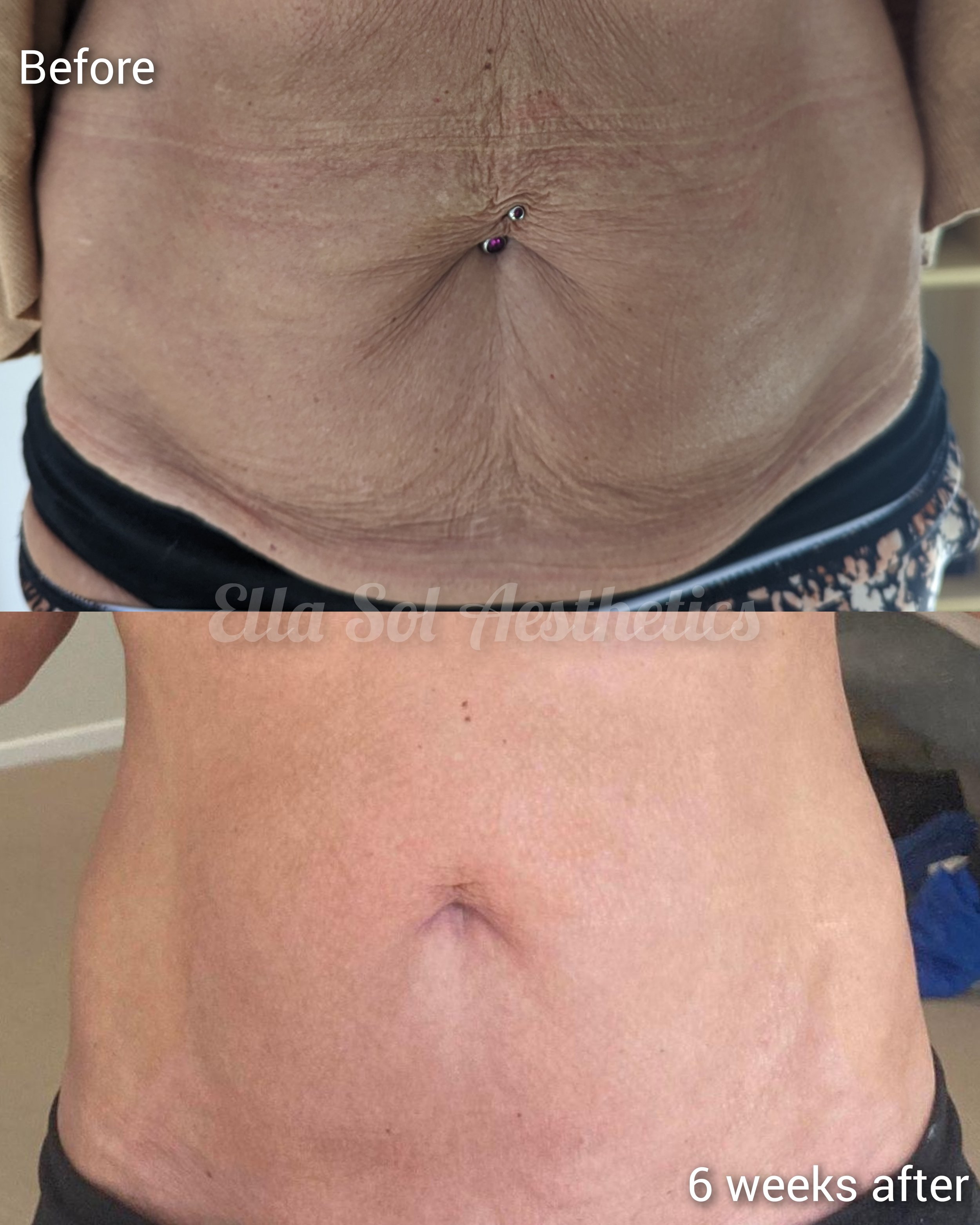 Fibroblast before and after on the stomach