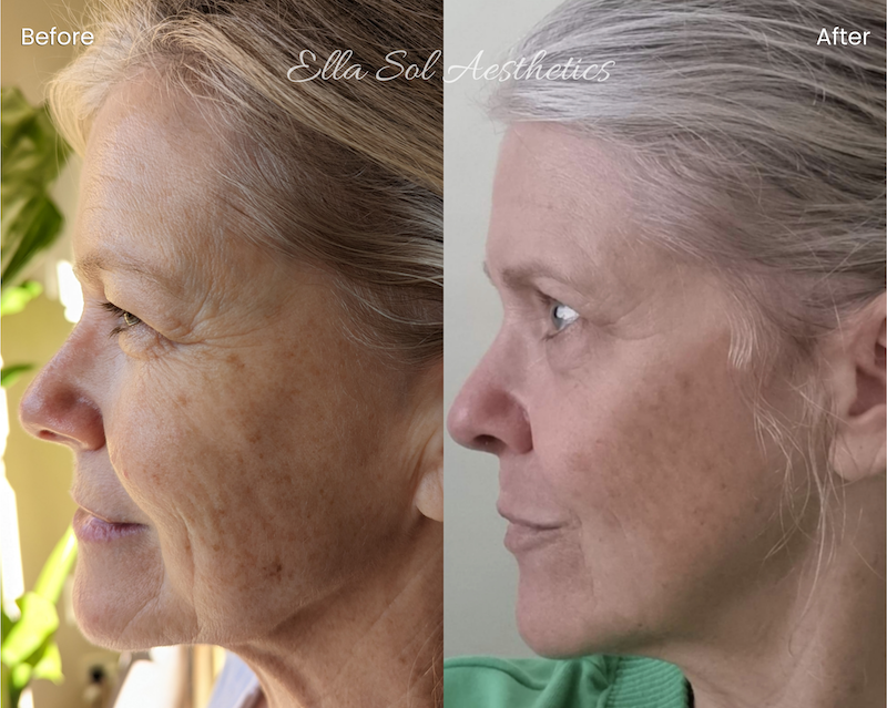Fibroblast before and after on eyes and smile lines. Also displays improvement on skin pigmentation