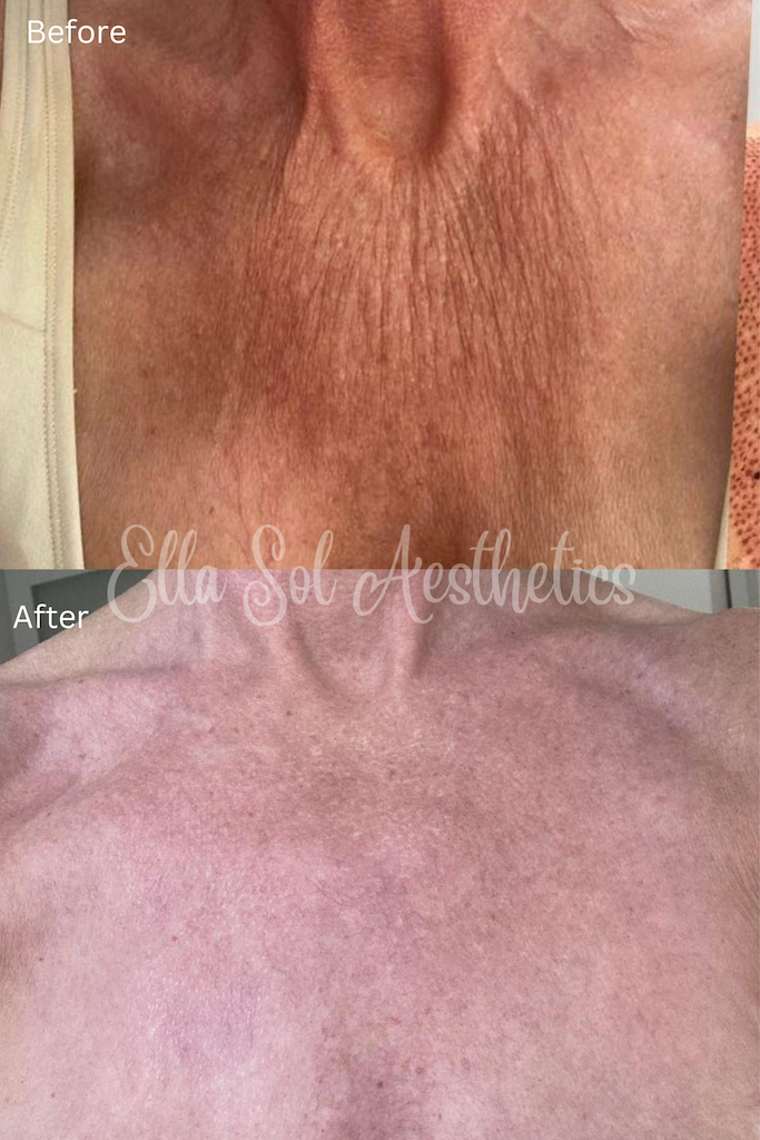 Fibroblast before and after on the décolletage