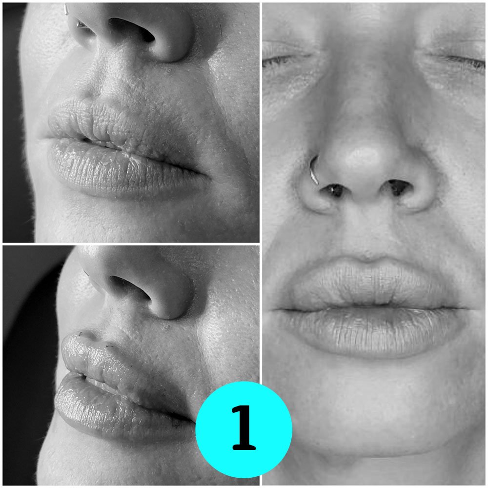 treating lips with dermal filler