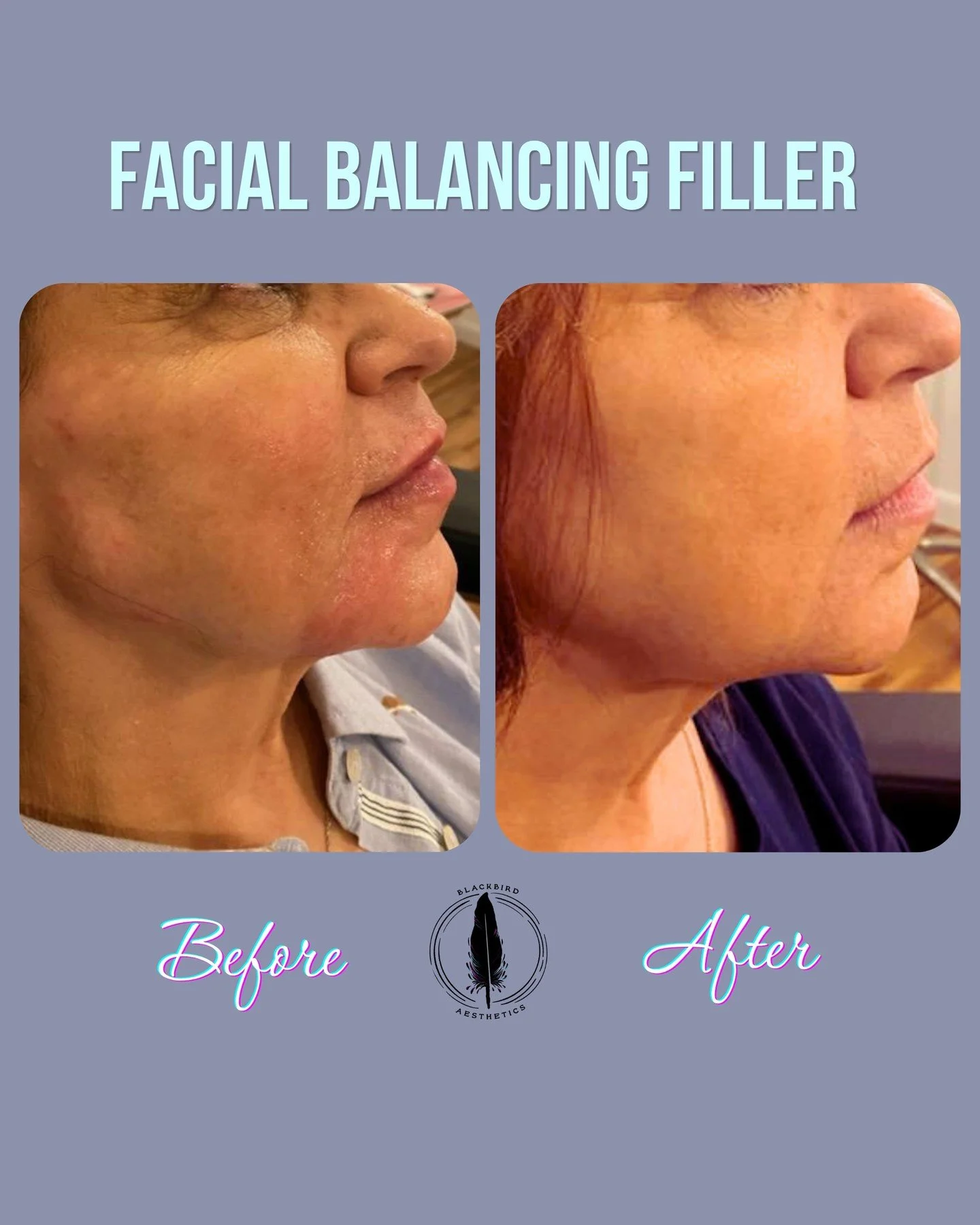Looking to balance your features? We can help you out! 😍 Our Facial Balancing Consultations break down exactly where to start and how to enhance your features for a naturally balanced look. Start with a $50 consultation, with the chance to apply the