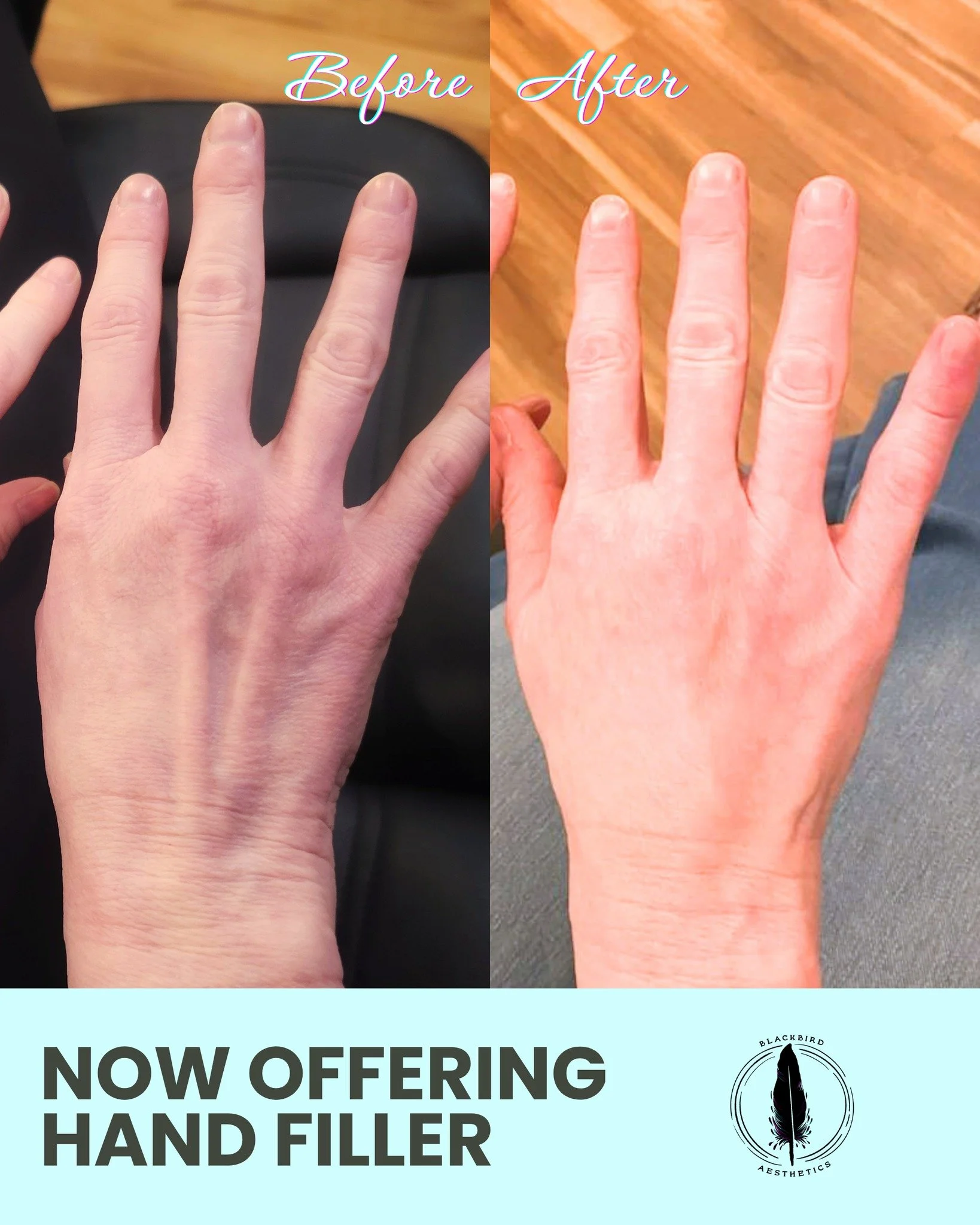 Feeling like you don't know the back of your hands so well anymore? We can help. Your hands see the sun far more than the rest of your body, so it's no surprise they age more quickly. We now offer hand filler with Radiesse, which is a type of dermal 