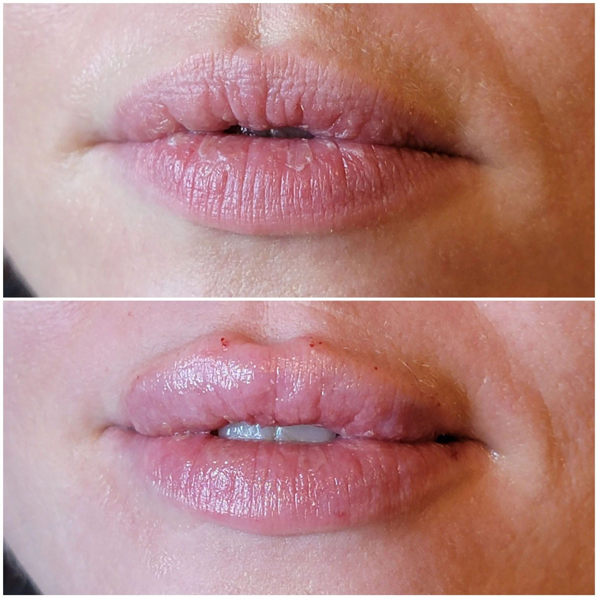 💌Incoming: Lip filler results! Book a lip filler consultation with the link in our bio!