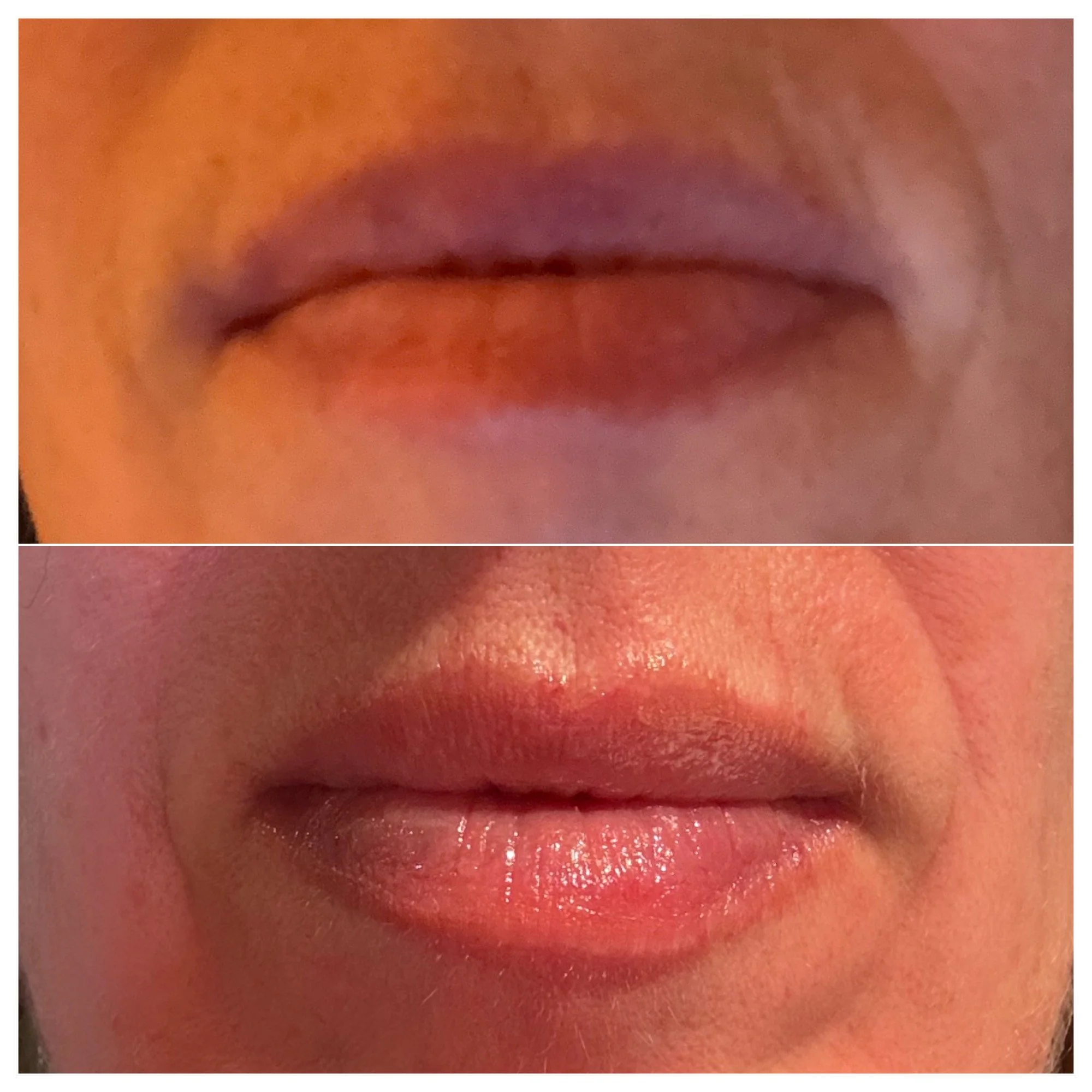 Looking for fuller looking lips? We&rsquo;ve got you! This client wanted a very natural look with more fullness.

💋Book a lip filler consultation today with the link in our bio!