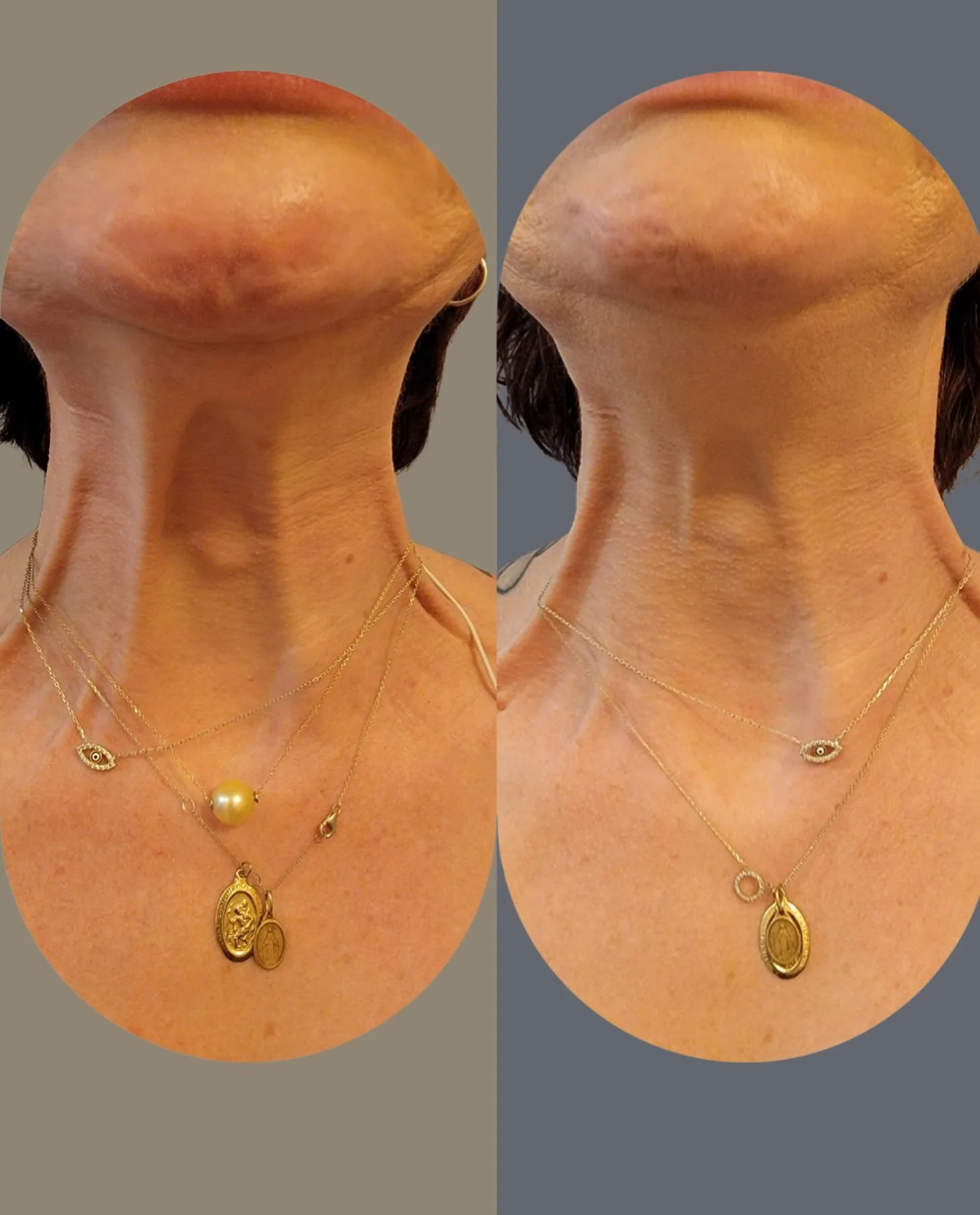 This client came to us seeking treatment of her vertical neck bands known as platysmal bands.  Our tox treatment helps to relax the overactive muscles of the neck to achieve a smoother and more contoured appearance.

The result is a beautifully refin