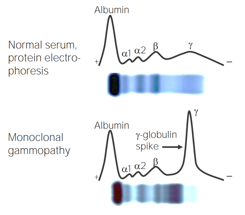 Episode 040 Myeloma Series, Pt.1 Intro to Testing and MGUS — The