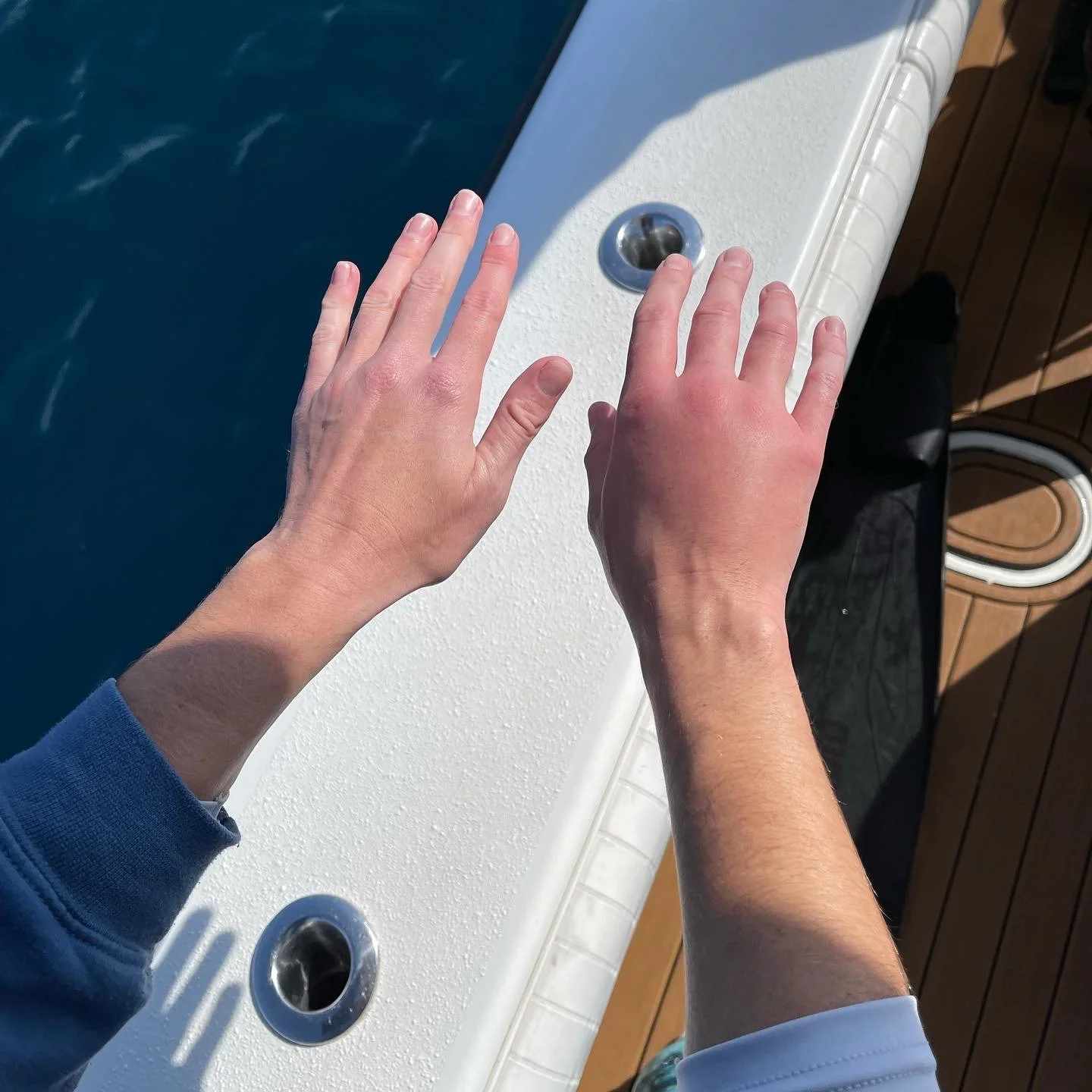 Swollen hand after the sting