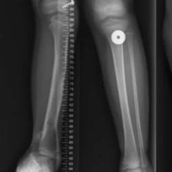 De-Identified Limb Differences.jpg