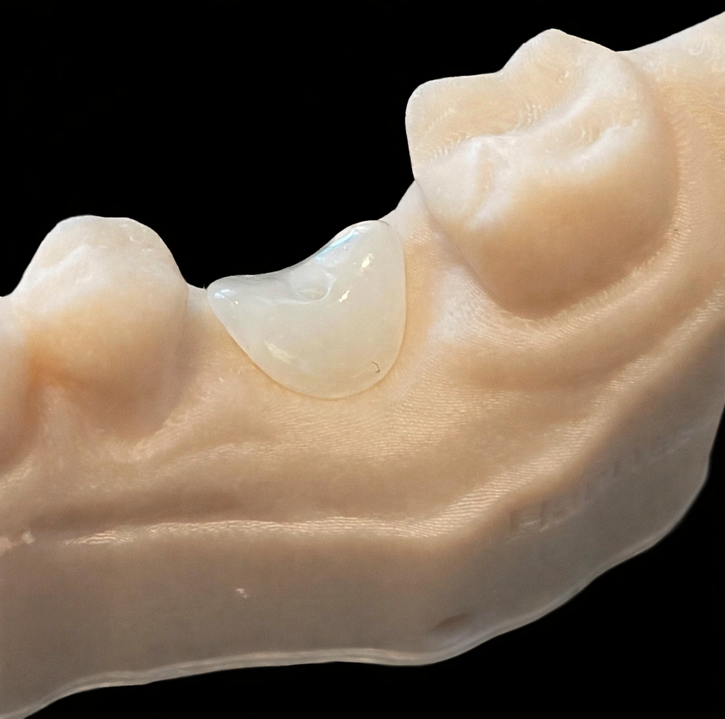 custom healing abutment, immediate load, soft tissue contouring